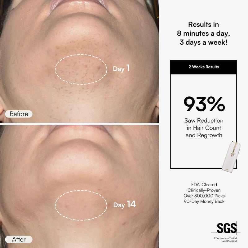 Nuvio IPL Hair Removal Device